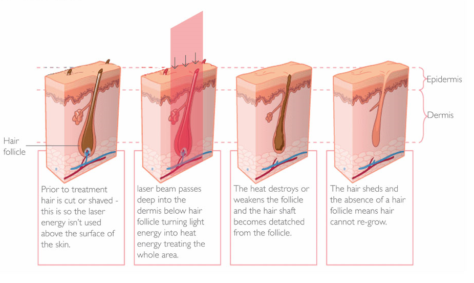 How does laser hair removal works.png