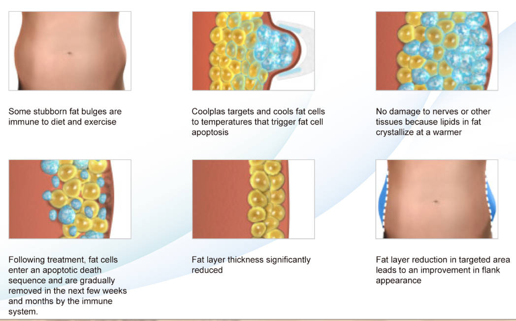 cryolipolysis.png