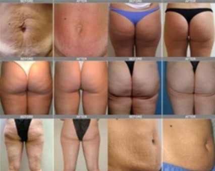 Kuma Cellulite removal.jpg