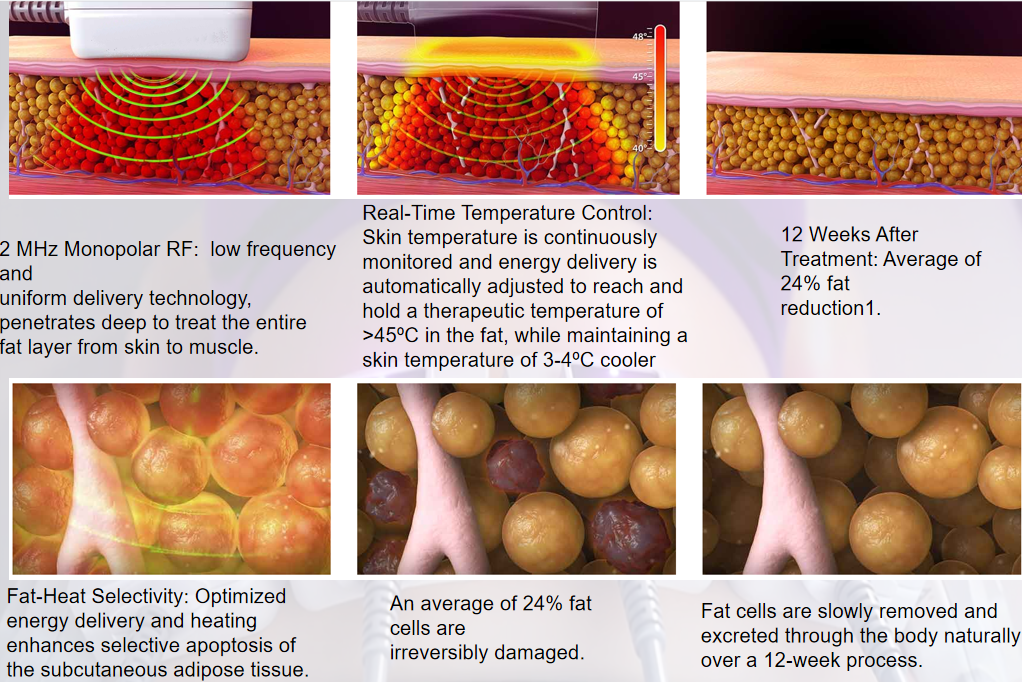 Trusculpt Monopolar RF Body Sculpt.png