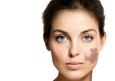 Pigmentation Removal