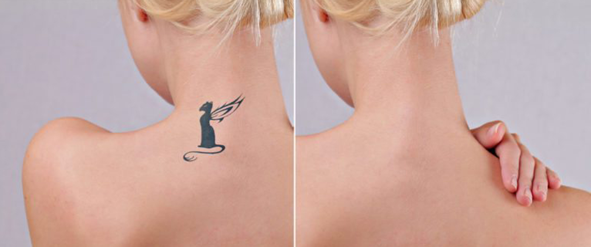 Laser Tattoo Removal