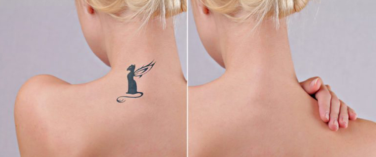 Laser Tattoo Removal