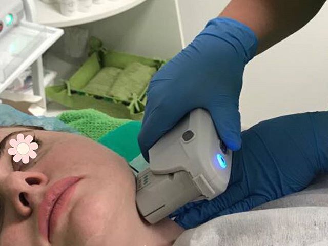 Face lift Neck Lift